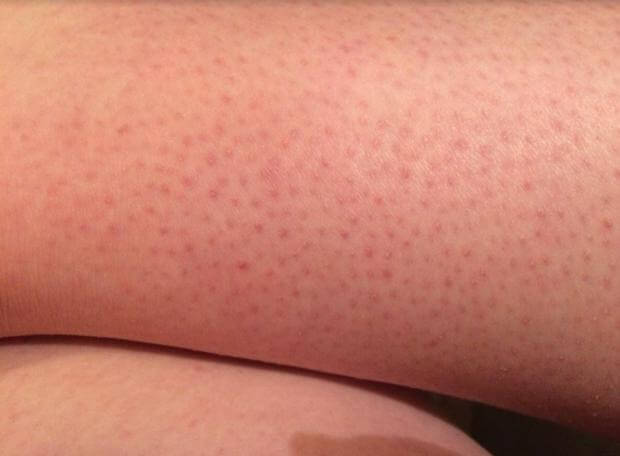 Red pimples after shaving