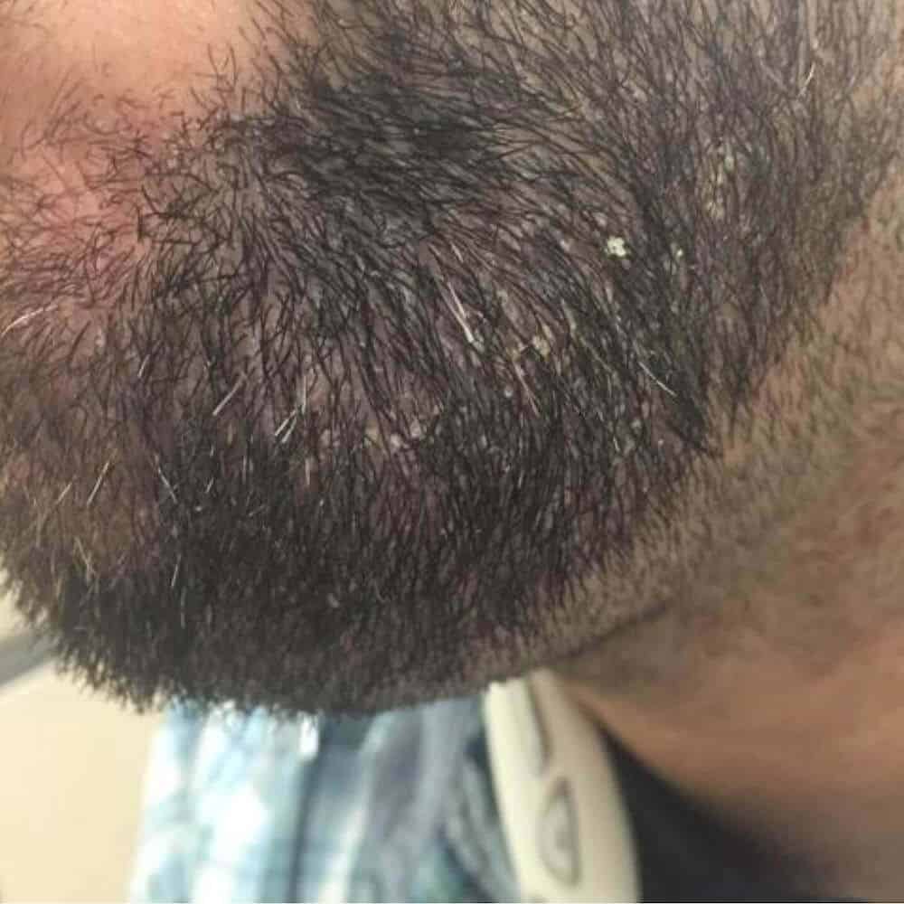Itchy, dry and irritated skin plagues many men, not just those with beards